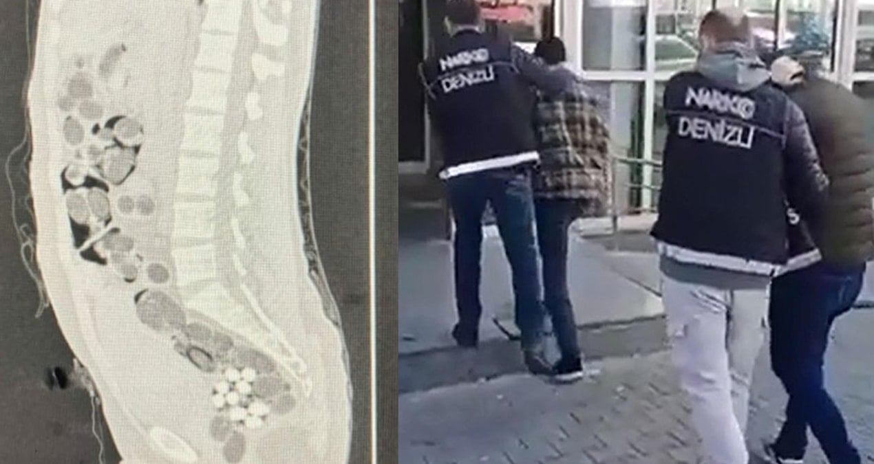 Yolcunun midesinden 219 paket uyuşturucu çıktı